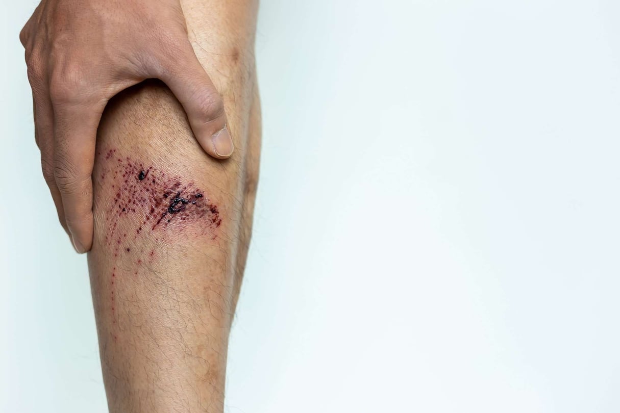 Don't wait to worry | Coral injury leads to severe infection