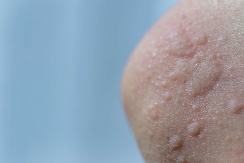 6 Tips for preventing skin conditions onboard yachts